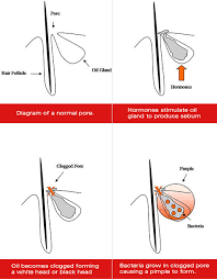 Understanding the acne